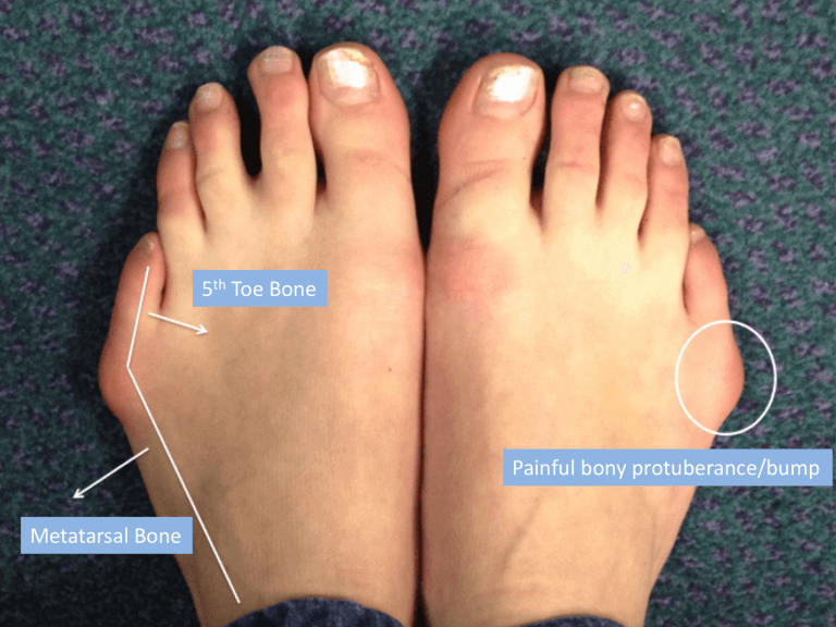 Deformity Treatment London Foot & Ankle Clinic